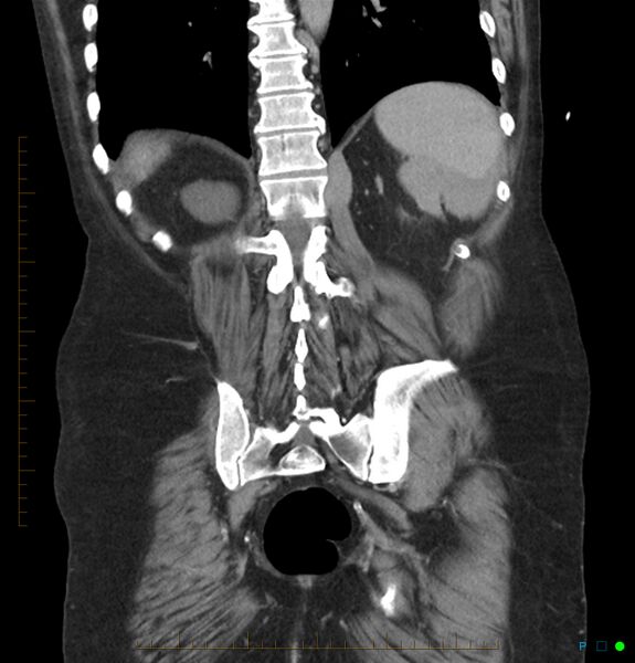 File:Acute renal failure post IV contrast injection- CT findings (Radiopaedia 47815-52559 Coronal C+ portal venous phase 29).jpg