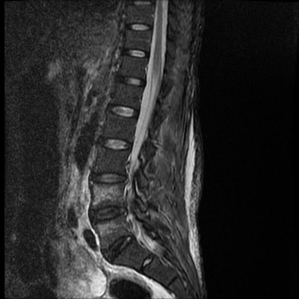 File:Acute vertebral body compression fractures (Radiopaedia 31757-32694 Sagittal STIR 7).jpg