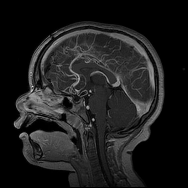 File:Adamantinomatous craniopharyngioma (Radiopaedia 77407-89529 H 60).jpg
