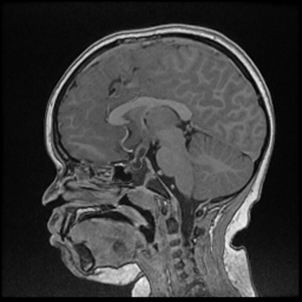 File:Adamantinomatous craniopharyngioma (Radiopaedia 77407-89529 Sagittal T1 C+ 65).jpg