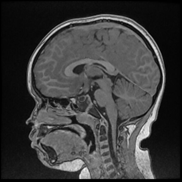 File:Adamantinomatous craniopharyngioma (Radiopaedia 77407-89529 Sagittal T1 C+ 68).jpg
