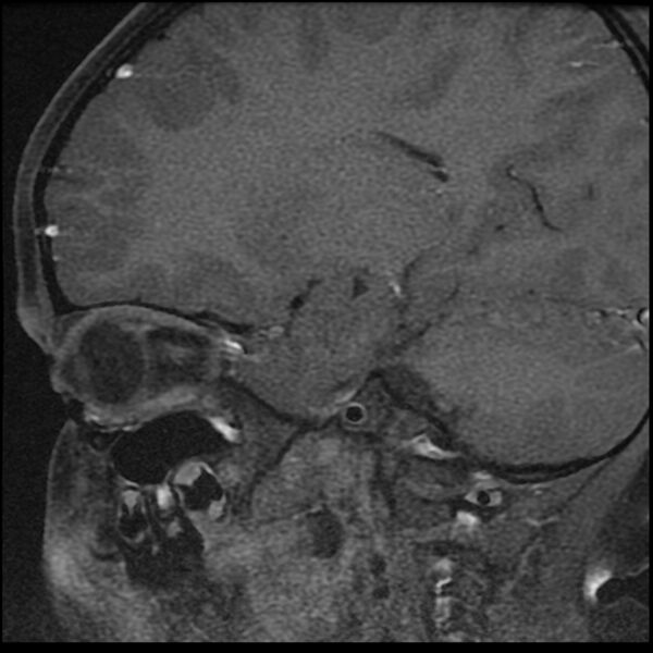 File:Adamantinomatous craniopharyngioma (Radiopaedia 77407-89529 Sagittal T1 C+ fat sat 1).jpg