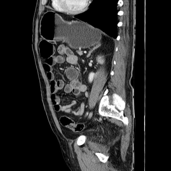 File:Adenocarcinoma of colon with entero-colic fistula (Radiopaedia 22832-22852 Sagittal C+ portal venous phase 42).jpg