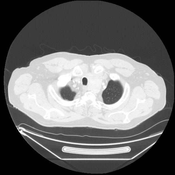 File:Adenocarcinoma of the lung (Radiopaedia 44876-48759 Axial lung window 5).jpg