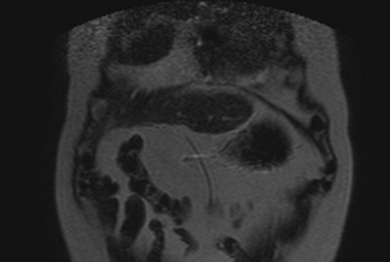 File:Adenomyomatosis of the gallbladder (Radiopaedia 12339).jpg