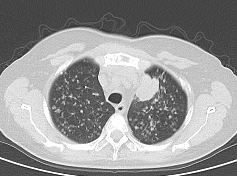 File:Adenosquamous lung carcinoma (Radiopaedia 22035-22030 lung window 20).jpg