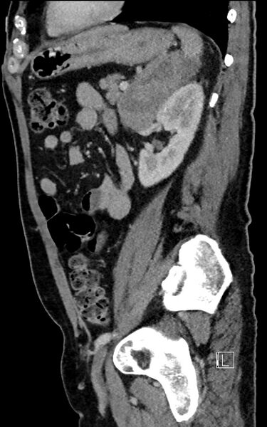 File:Adrenal lymphoma (Radiopaedia 73730-84529 Sagittal C+ portal venous phase 77).jpg