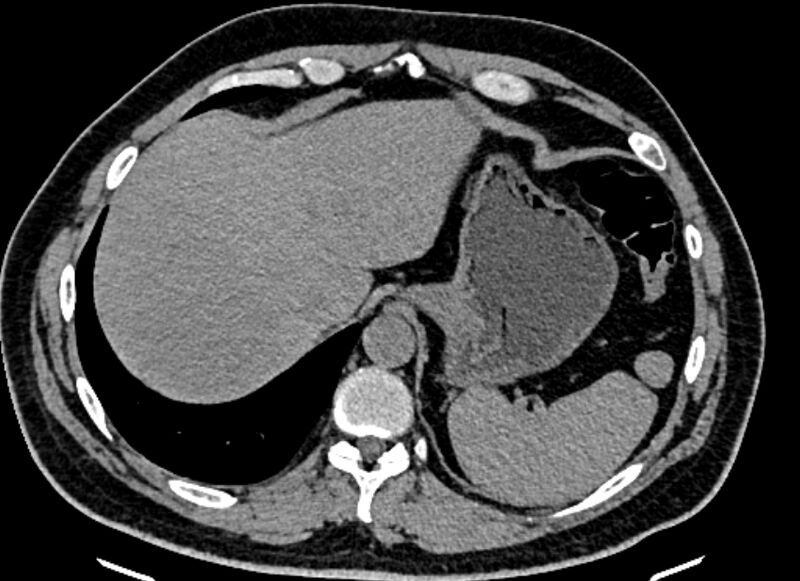 File:Adrenal metastases (Radiopaedia 73082-83791 Axial non-contrast 28).jpg