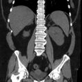 Adrenal myelolipoma (Radiopaedia 8216-9068 non-contrast 11).jpg