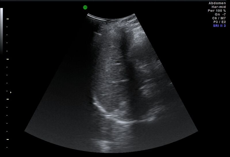 File:Adrenal myelolipoma - bilateral (Radiopaedia 74805-85811 Abdominal ultrasound 15).jpg