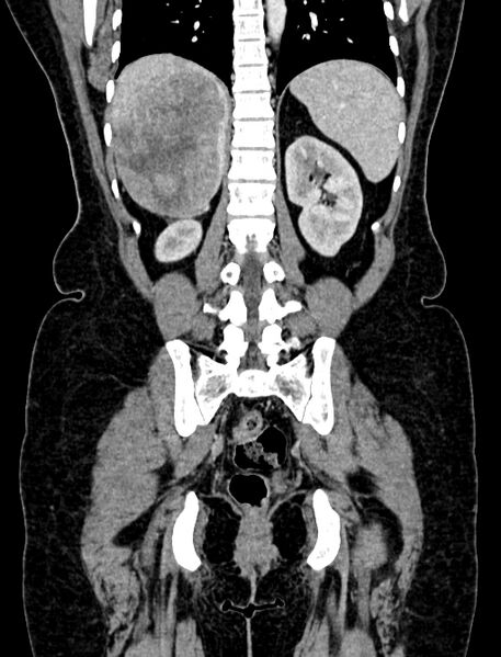 File:Adrenocortical carcinoma (Radiopaedia 87281-103569 Coronal C+ portal venous phase 98).jpg