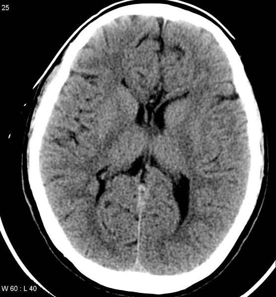 File:Aicardi syndrome (Radiopaedia 5353-7116 Axial non-contrast 22).jpg