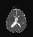 Aicardi syndrome (Radiopaedia 66029-75205 Axial ADC 14).jpg