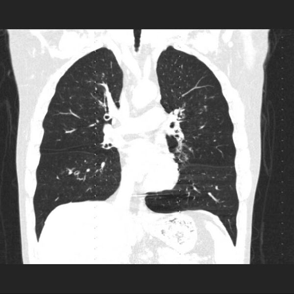 File:Allergic bronchopulmonary aspergillosis (Radiopaedia 21386-21320 Coronal lung window 8).jpg