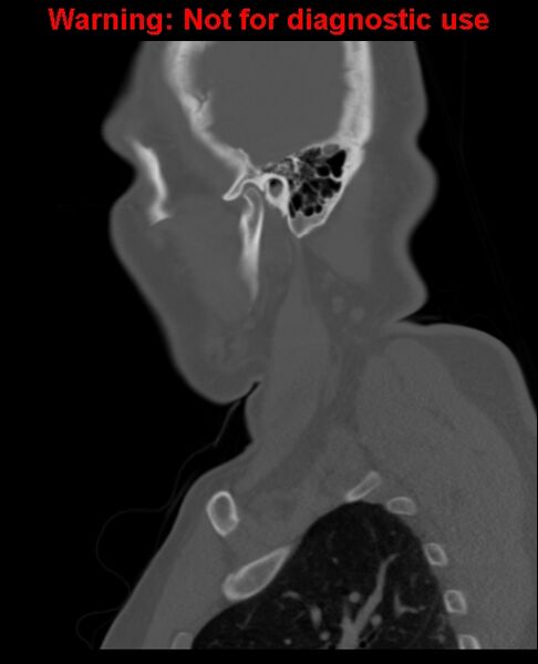 File:Ameloblastoma (Radiopaedia 33126-34164 Sagittal bone window 59).jpg