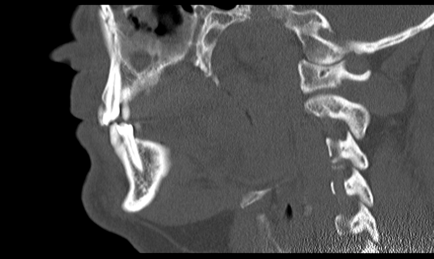 Ameloblastoma (Radiopaedia 33677-34806 Sagittal bone window 38).png