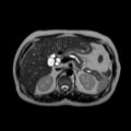Ampullary tumor (Radiopaedia 27294-27479 T2 16).jpg