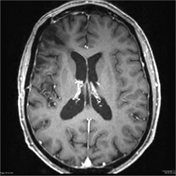File:Anaplastic meningioma with recurrence (Radiopaedia 34452-35788 Axial T1 C+ 84).jpg