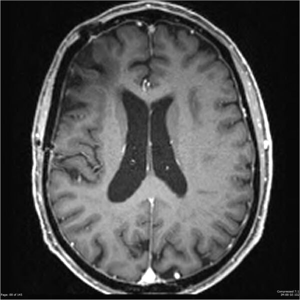 File:Anaplastic meningioma with recurrence (Radiopaedia 34452-35788 Axial T1 C+ 88).jpg