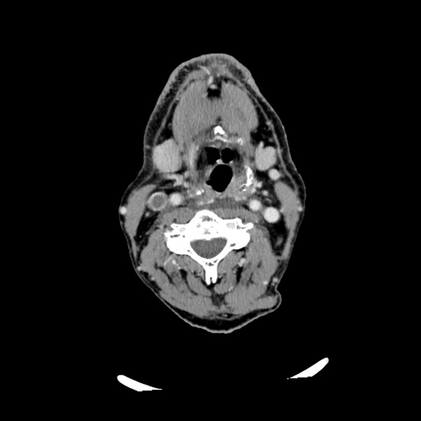 Anaplastic thyroid carcinoma (Radiopaedia 79087-92034 B 73).jpg