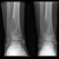 Aneurysmal bone cyst (Radiopaedia 7495-8321 Frontal 1).jpg