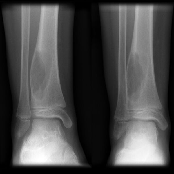 File:Aneurysmal bone cyst (Radiopaedia 7495-8321 Frontal 1).jpg