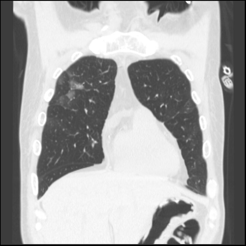 Angioinvasive aspergillosis (Radiopaedia 43957-47466 Coronal lung window 72).jpg