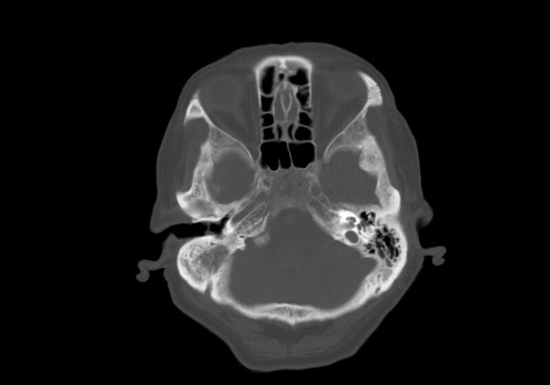File:Anomalous intracranial venous drainage (Radiopaedia 28161-28418 Axial bone window 7).jpg