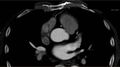 Anomalous left coronary artery- prepulmonic course (Radiopaedia 29253-29667 A 7).JPG