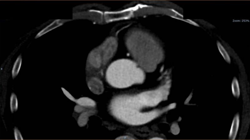 File:Anomalous left coronary artery- prepulmonic course (Radiopaedia 29253-29667 A 7).JPG