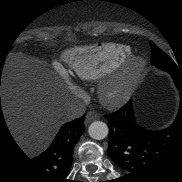 File:Anomalous origin of left circumflex artery from right coronary sinus (Radiopaedia 72563-83117 B 149).jpg