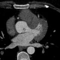 Anomalous origin of the left coronary artery with malignant course (Radiopaedia 77842-90126 C 96).jpeg