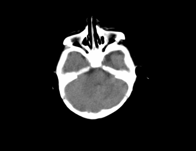 File:Anterior plagiocephaly (Radiopaedia 71836-82273 Axial non-contrast 4).jpg