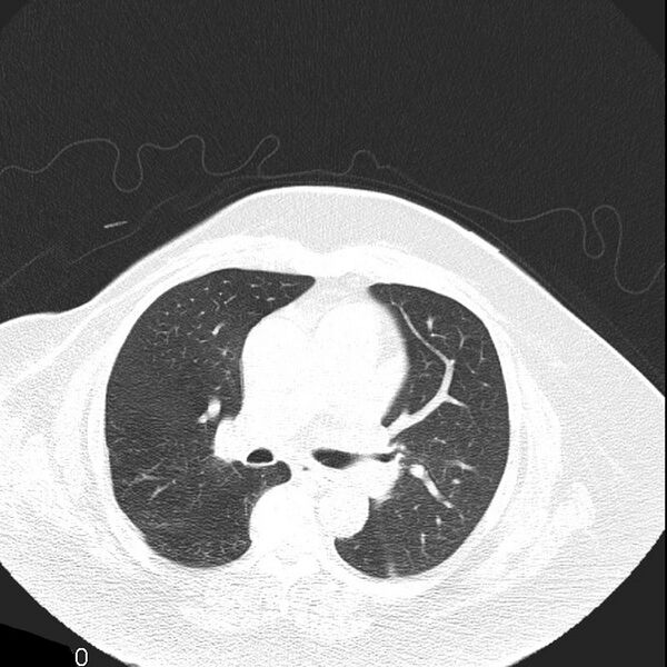 File:Aortic arch false aneurysm (Radiopaedia 14667-14587 Axial lung window 12).jpg