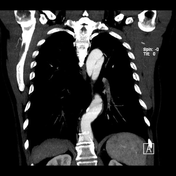 File:Aortic dissection - De Bakey type III - Stanford B (Radiopaedia 21903-21882 C 18).jpg