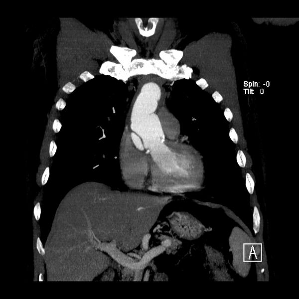 File:Aortic dissection - De Bakey type III - Stanford B (Radiopaedia 21903-21882 C 2).jpg