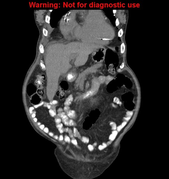File:Aortic graft infection (Radiopaedia 44979-48907 non-contrast 14).jpg