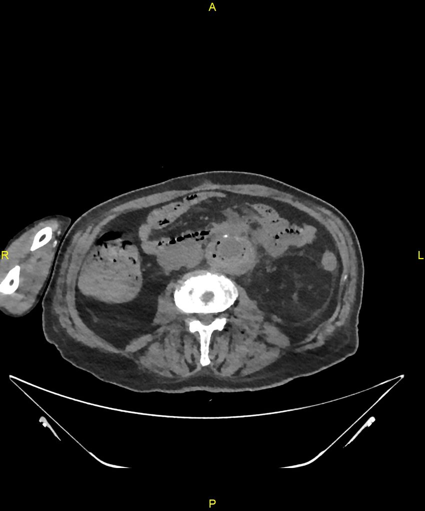 Aortoenteric fistula (Radiopaedia 84308-99603 Axial non-contrast 189).jpg