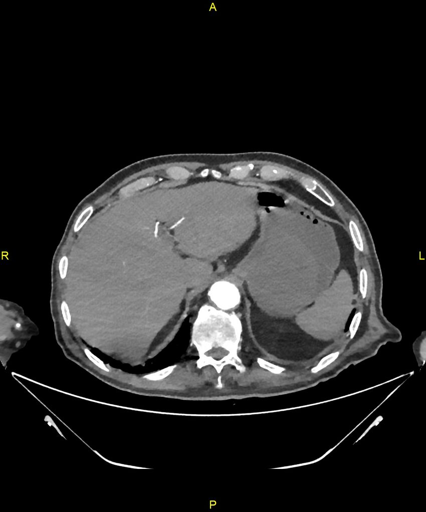 Aortoenteric fistula (Radiopaedia 84308-99603 B 45).jpg