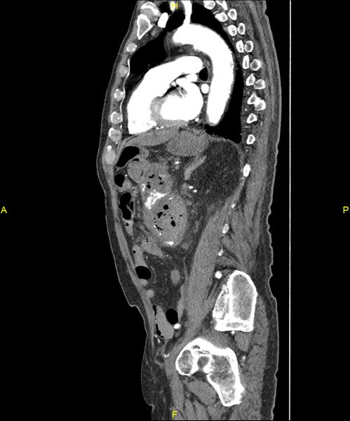 File:Aortoenteric fistula (Radiopaedia 84308-99603 C 216).jpg