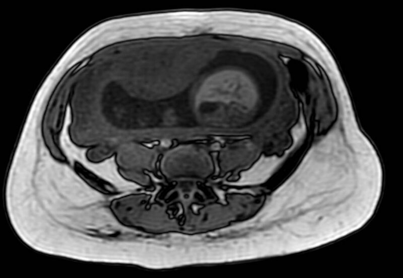 File:Appendicitis in gravida (MRI) (Radiopaedia 89433-106395 D 44).jpg
