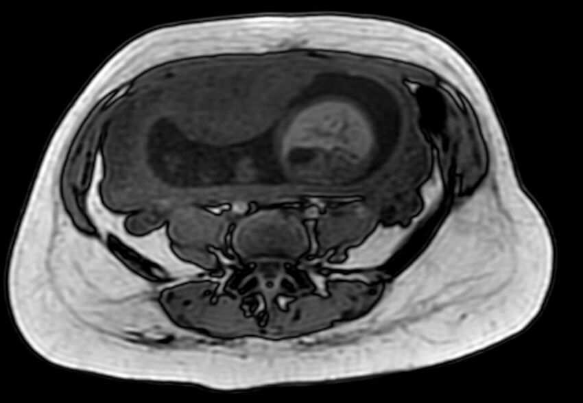 Appendicitis in gravida (MRI) (Radiopaedia 89433-106395 D 44).jpg