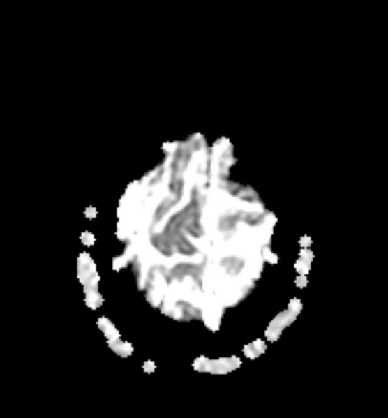 File:Arachnoid cyst- extremely large (Radiopaedia 68741-78451 Axial ADC 24).jpg