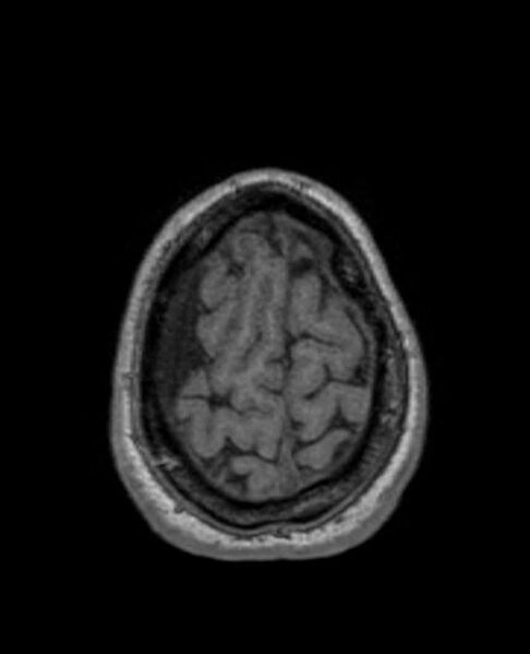 File:Arachnoid cyst- extremely large (Radiopaedia 68741-78451 Axial T1 70).jpg