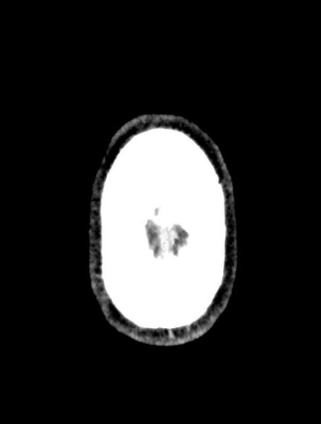 File:Arrow injury to the face (Radiopaedia 73267-84011 Axial C+ delayed 76).jpg