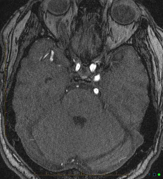 File:Artifactual basilar artery stenosis due to metallic stent (Radiopaedia 31206-31922 Axial MRA 12).jpg