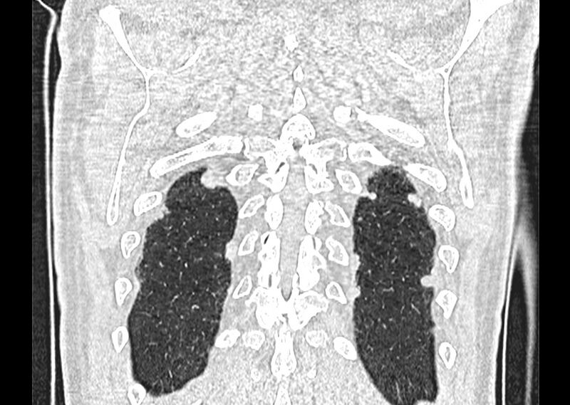 File:Asbestos pleural placques (Radiopaedia 57905-64872 Coronal lung window 264).jpg