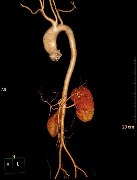 File:Ascending aortic pseudoaneurysm (Radiopaedia 28638-28910 D 29).jpg