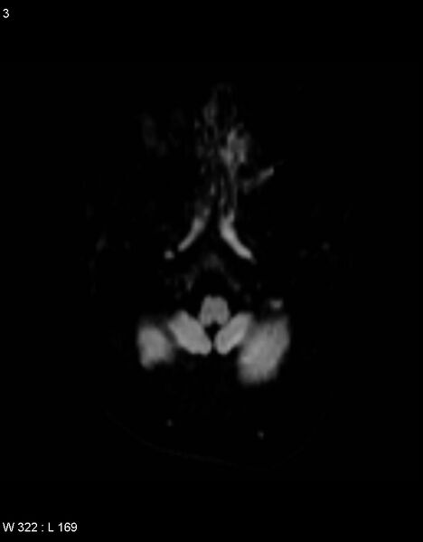 File:Astroblastoma (Radiopaedia 39792-42217 Axial DWI 2).jpg