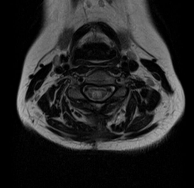File:Astrocytoma - spinal cord (Radiopaedia 69769-79758 Axial T2 11).jpg